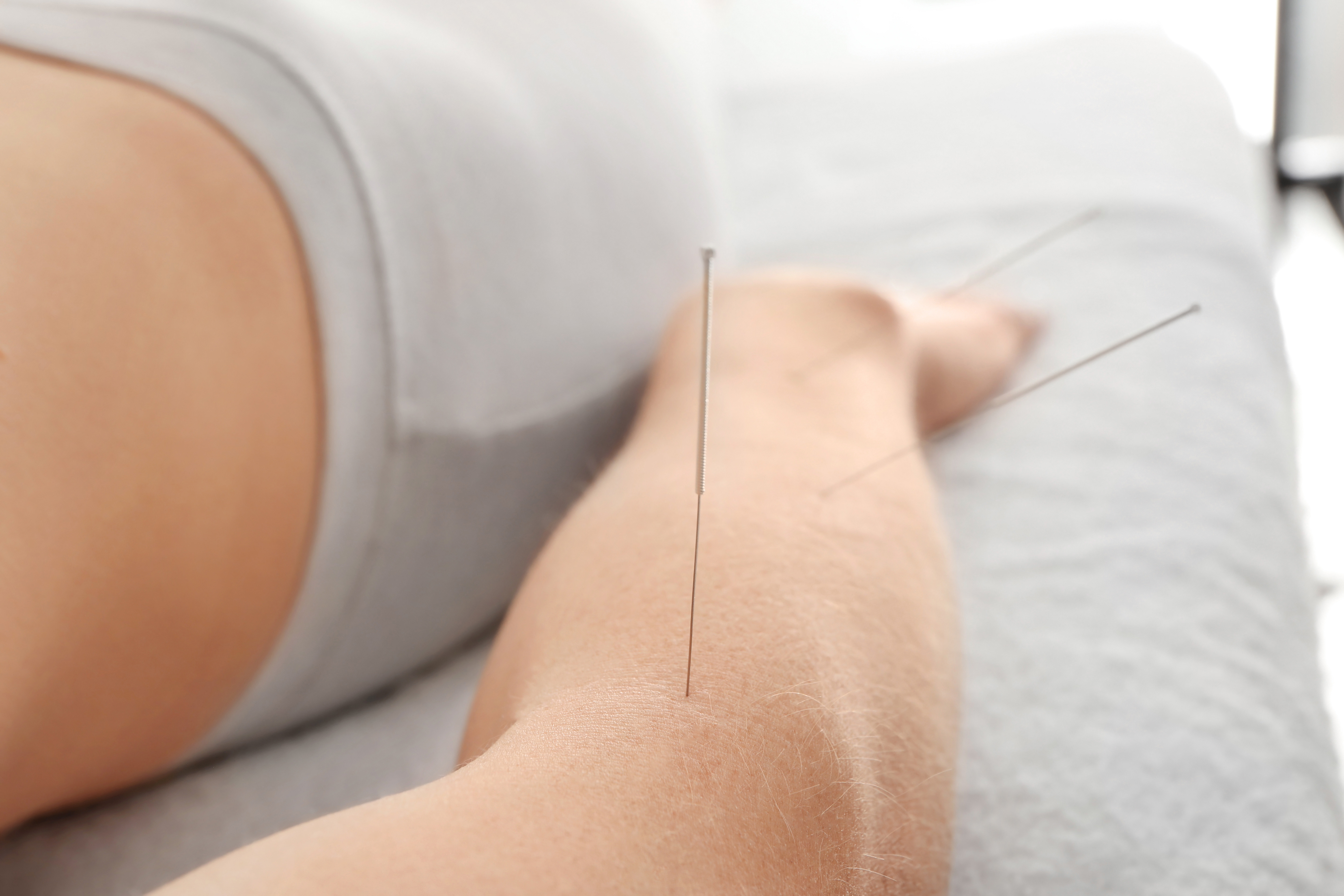 Acupuncture_AdobeStock_144478659